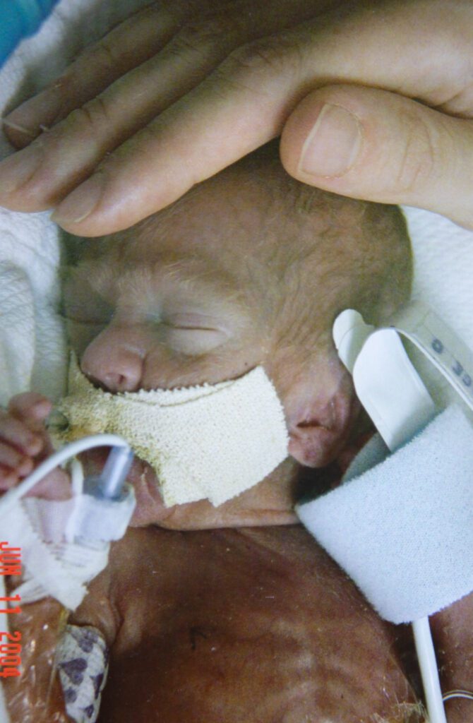 Adrian Cairns born as a micro-preemie baby with a loving hand rubbing their head.