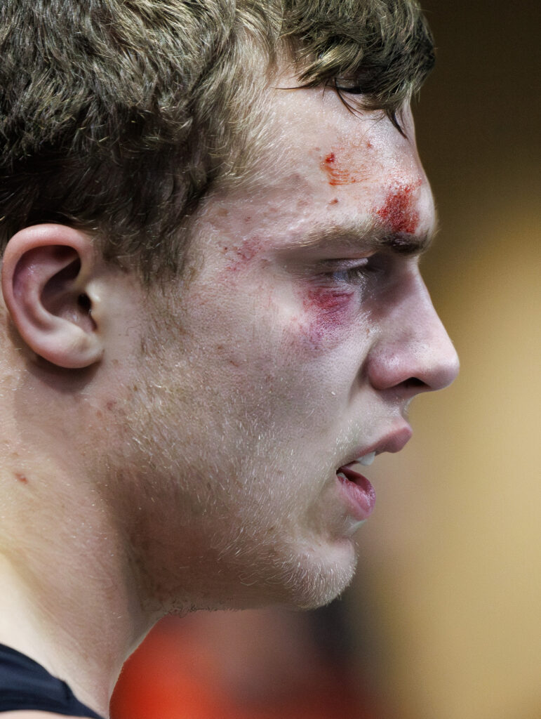 The face of Meridian’s Rhett Duersch shows the effects of his day of wrestling.